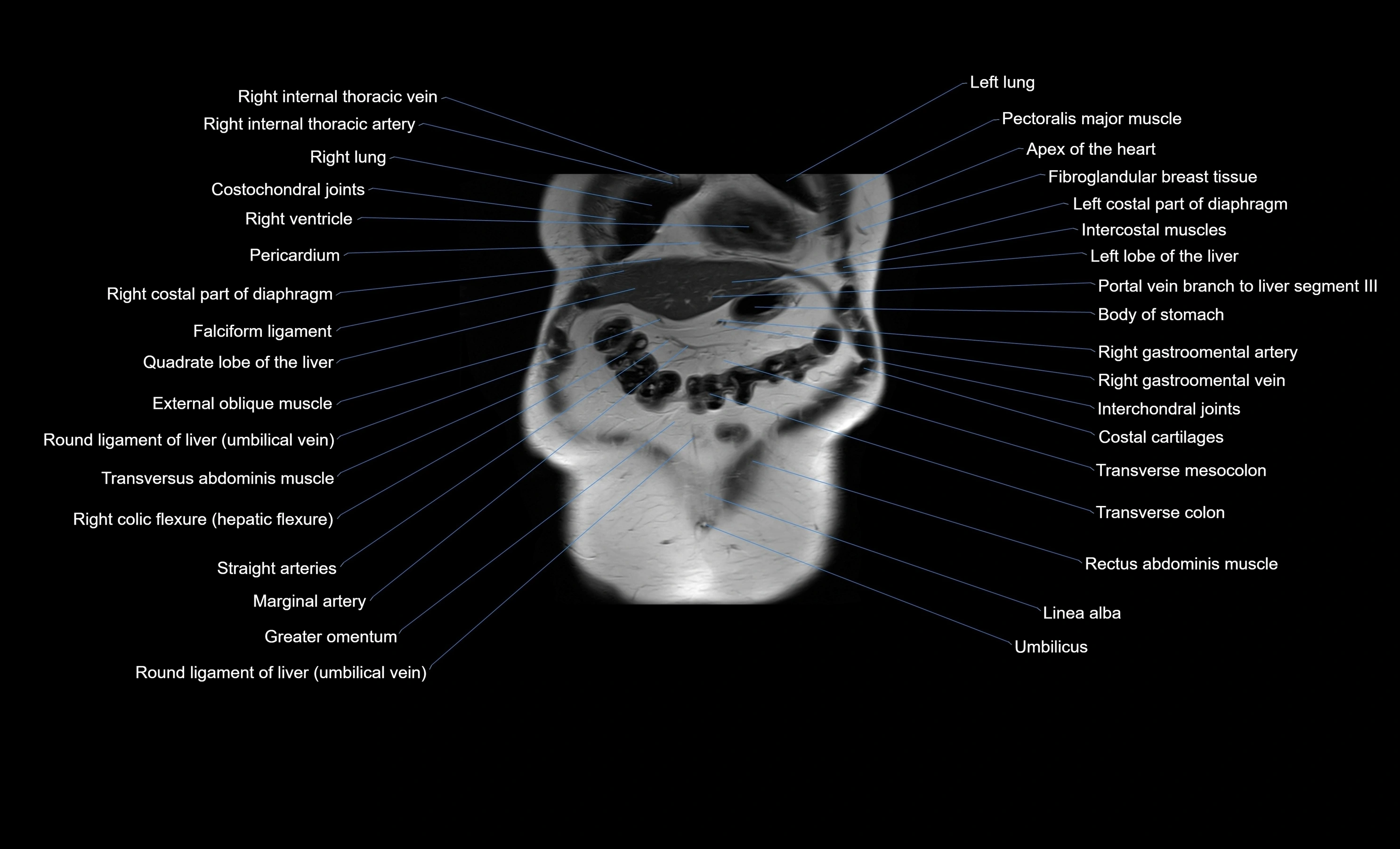 MRI Abdomen coronal labelled cross sectional anatomy radiology  image-img-00001-00011.webp